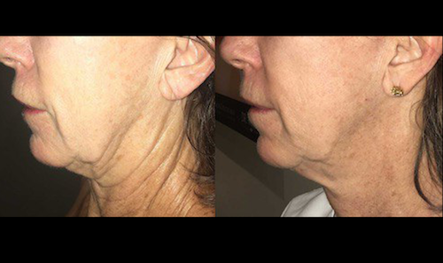 rf laser skin tightening wrinkle reducttion before after mississauga oakville